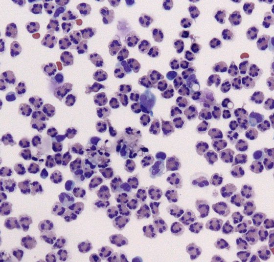 meningitis_bakteriell