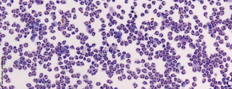 meningitis_bakteriell