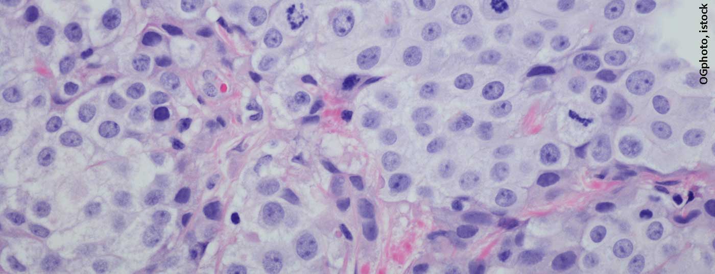 blasenkrebs_istock-599146372