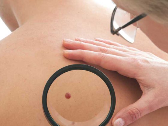 haut_hautkrebs_muttermal_untersuchung