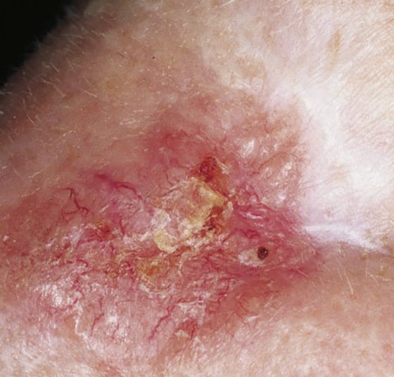 hautkrebs-hell_scar-like_morphea-like_bcc