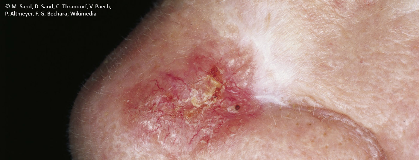 hautkrebs-hell_scar-like_morphea-like_bcc
