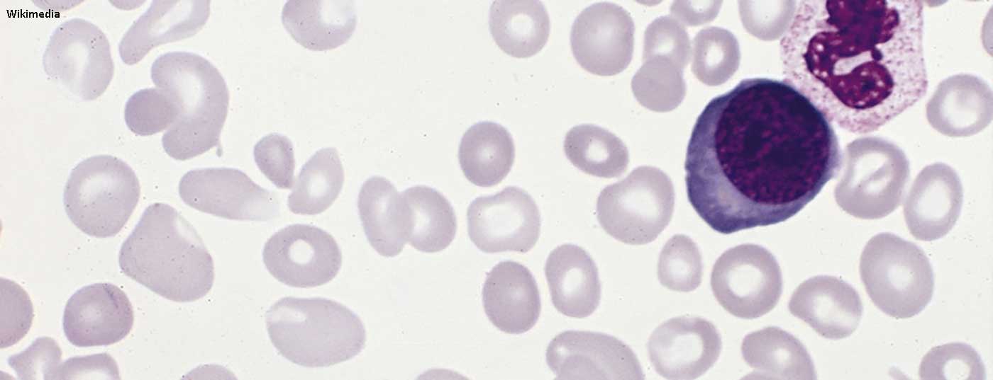 polycythemia_vera_blood_smear
