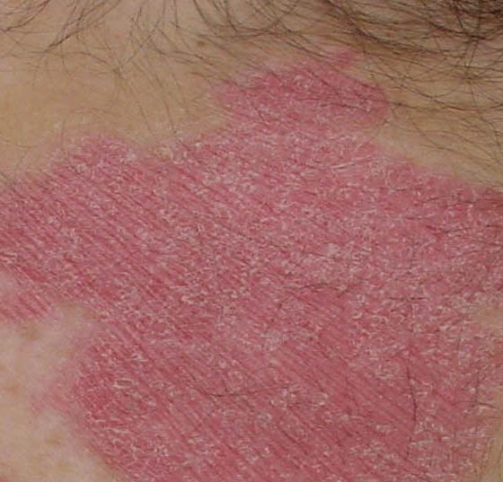 psoriasis_schuppenflechte
