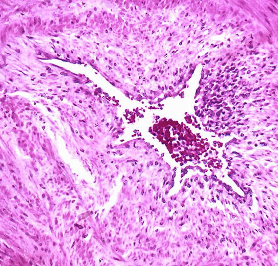 pulmonale-hypertonie_wiki