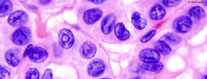 schilddrusenkrebs_papillar