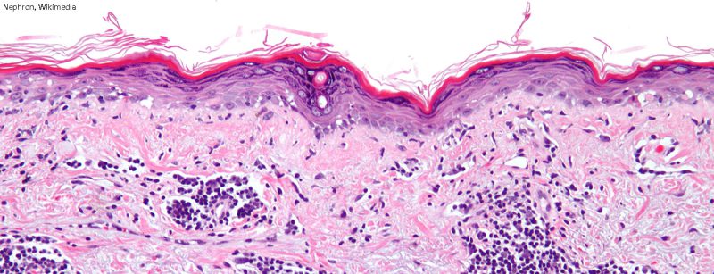 lupus_sle