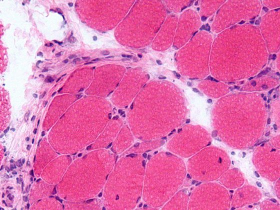 dermatomyositis_wikimedia