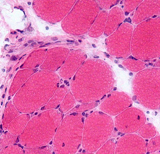 dermatomyositis_wikimedia