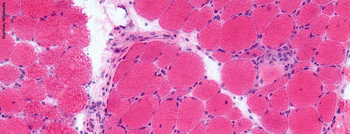 dermatomyositis_wikimedia