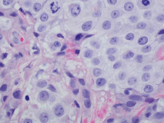 blasenkrebs_istock-599146372