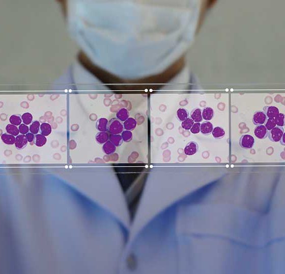 leukaemie_aml_istock-1142558430