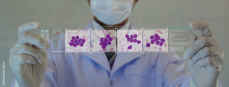 leukaemie_aml_istock-1142558430