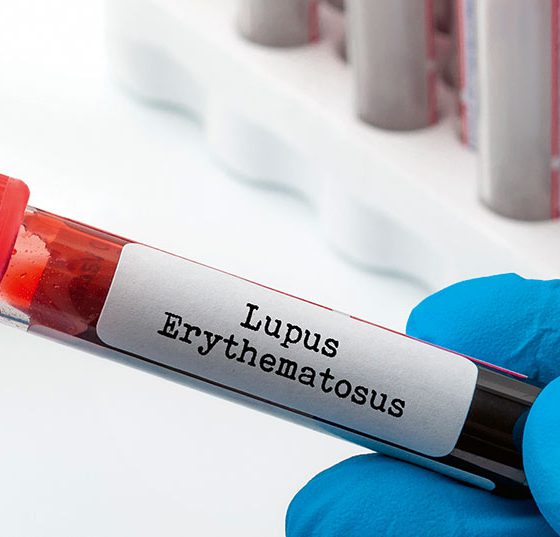 lupus_sle_istock-1210670543