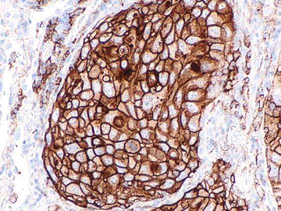nsclc_lungenkrebs_nicht_kleinzellig