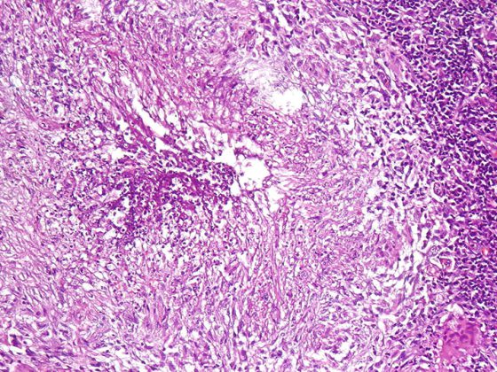 tuberkulose_lunge_wikipedia