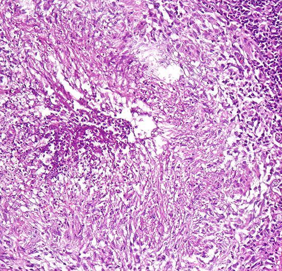 tuberkulose_lunge_wikipedia