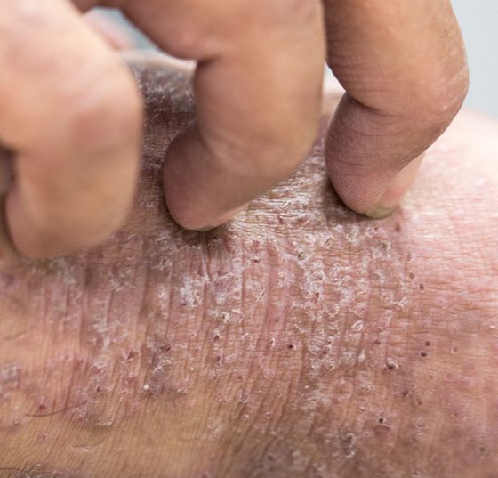 dermatitis