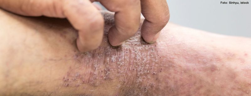 dermatitis