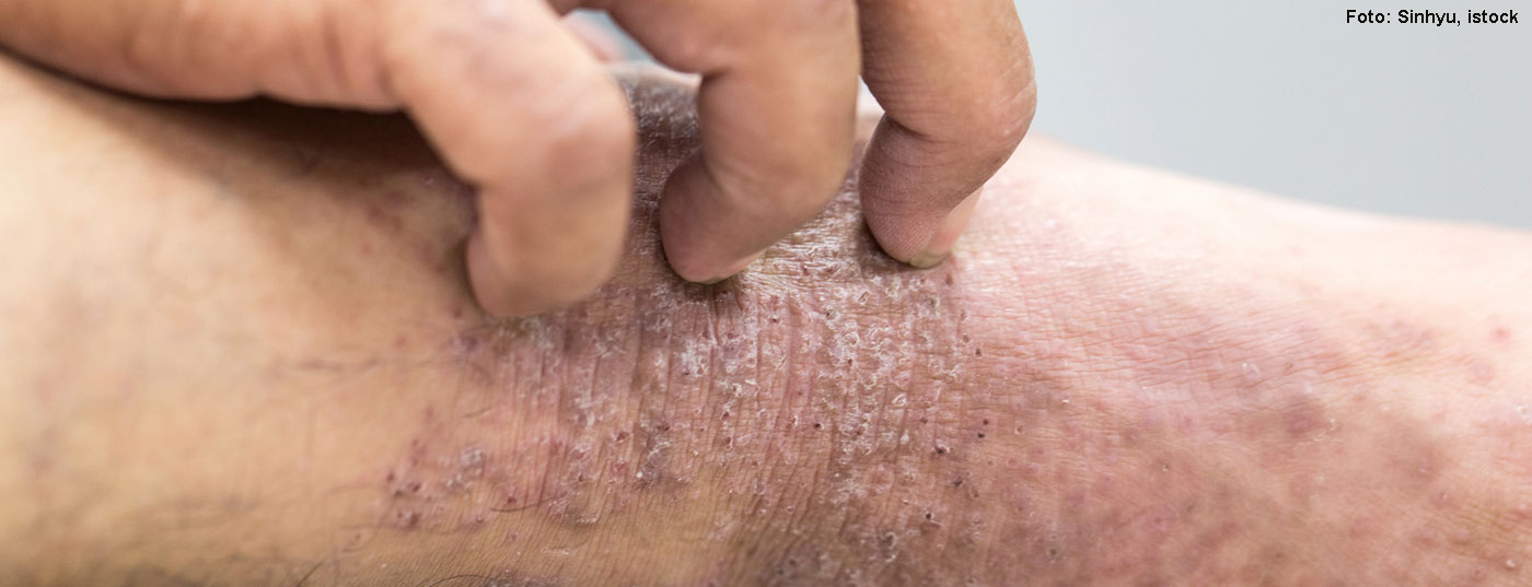 dermatitis