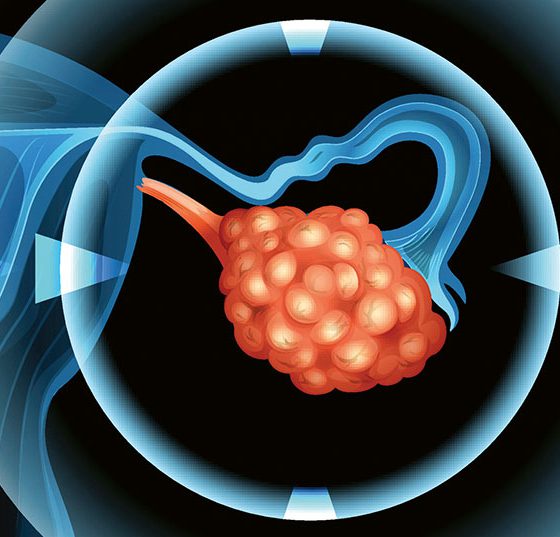 eierstock_istock-488625288