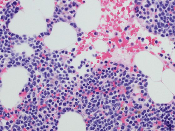 multiples_myelom_istock-680804780