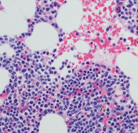 multiples_myelom_istock-680804780