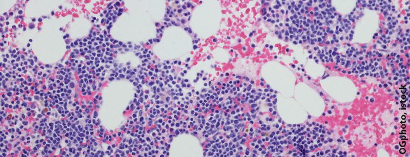 multiples_myelom_istock-680804780