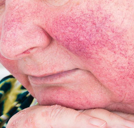 rosacea_istock-614739992