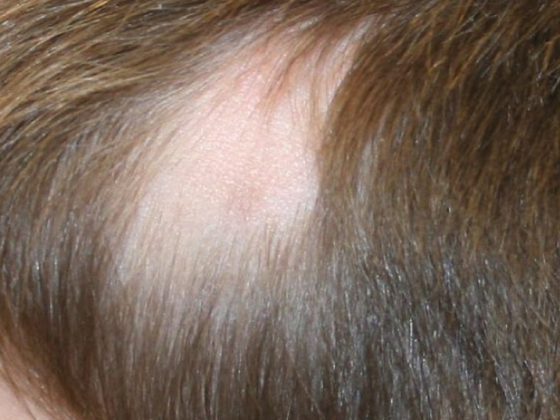 alopecia_dp4