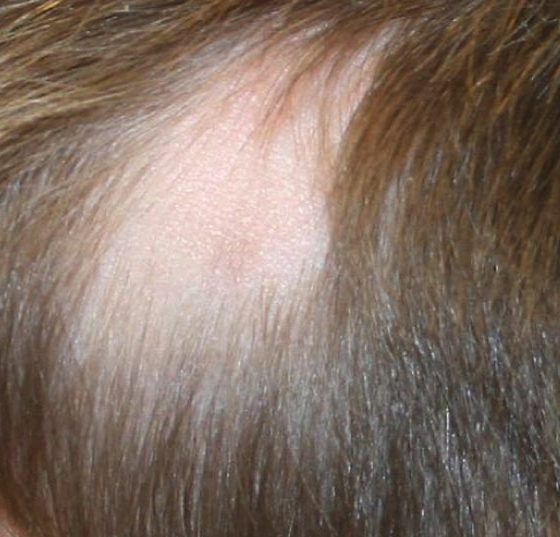 alopecia_dp4
