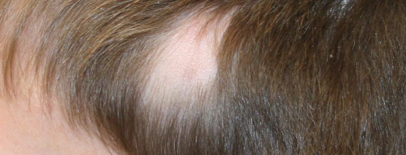 alopecia_dp4
