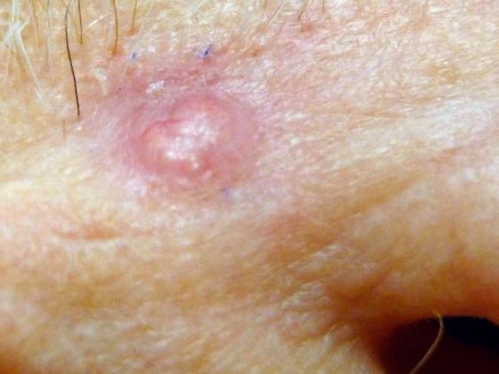 basalzellkarzinom_weisserhautkrebs