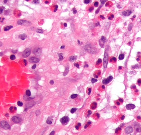 churg-strauss_wikimedia