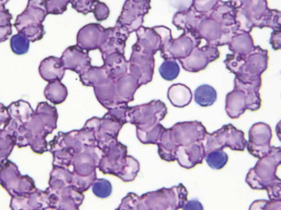 cll_leukaemie_istock-966964984