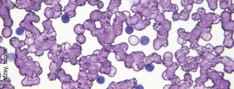 cll_leukaemie_istock-966964984