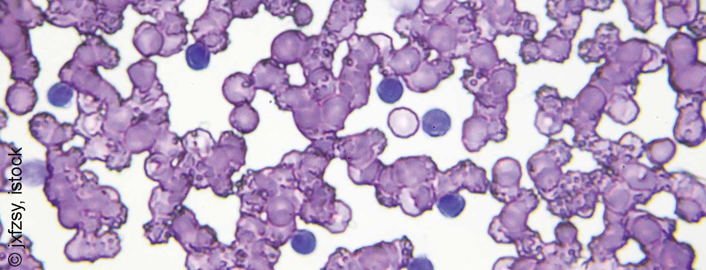 cll_leukaemie_istock-966964984