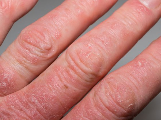 psoriasis-arthritis_istock-1176340885