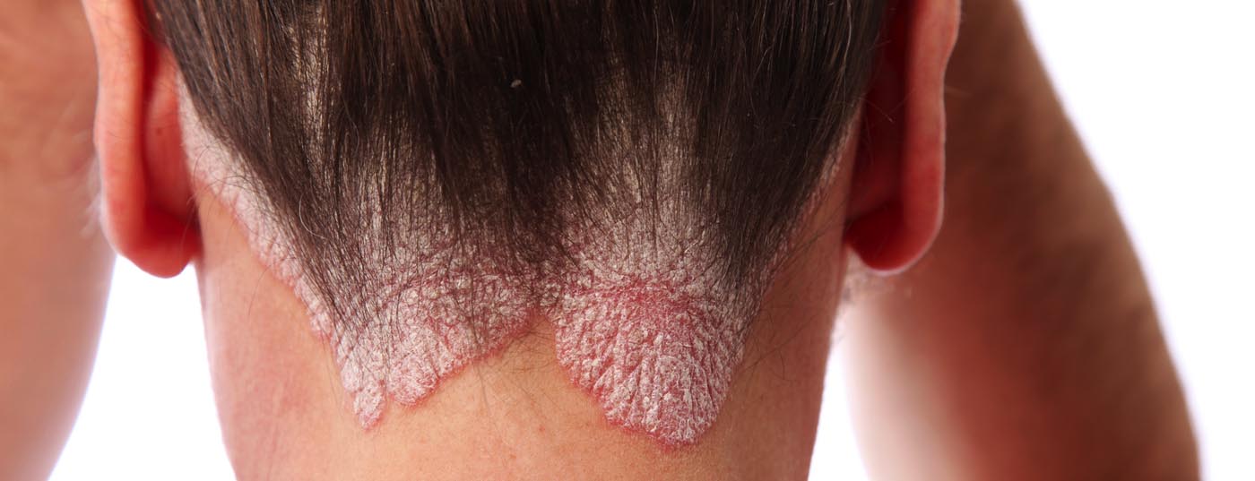 schuppenflechte_psoriasis