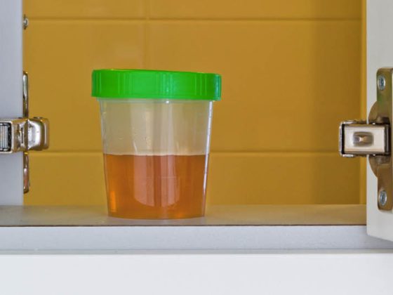 urin_harn_blase_urinprobe