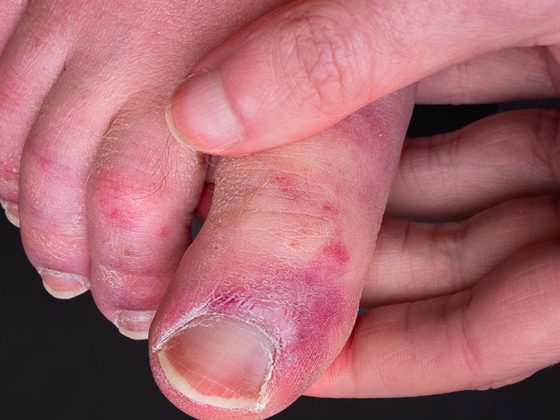 covidtoe_istock-1250715080