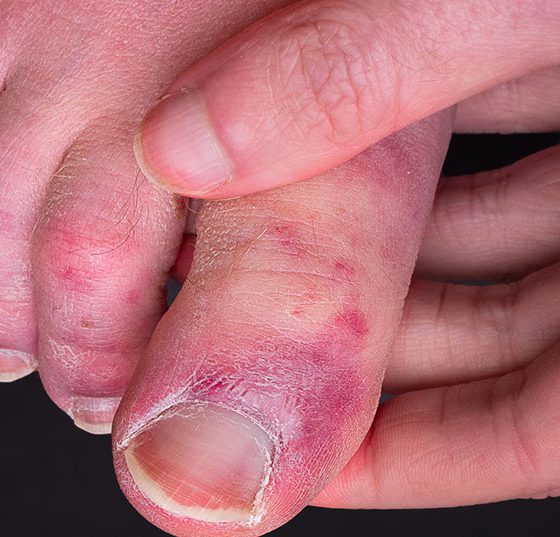 covidtoe_istock-1250715080