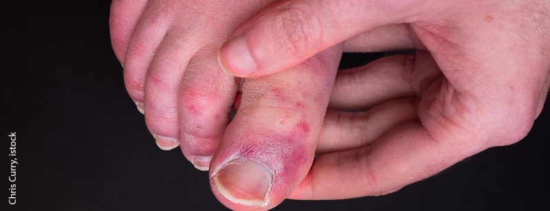 covidtoe_istock-1250715080