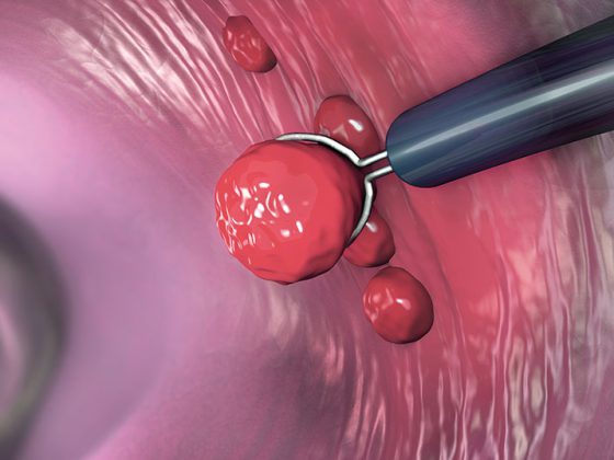 darm_darmkrebs_istock-1136901766