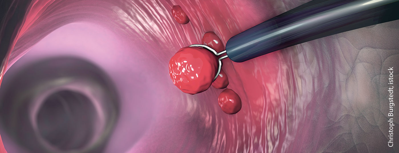 darm_darmkrebs_istock-1136901766