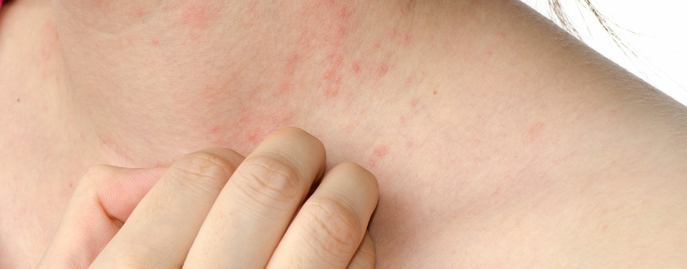 juckreiz_istock-155026780