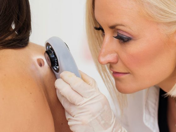 melanom_hautkrebs_485083156