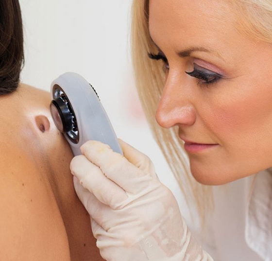 melanom_hautkrebs_485083156