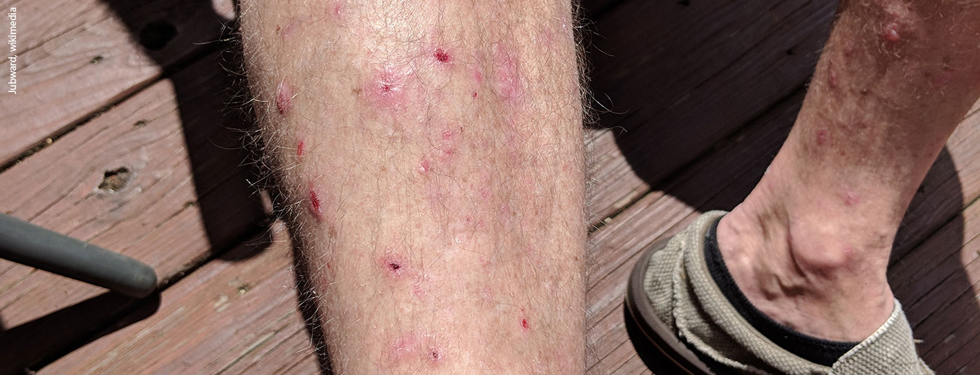 pemphigoid