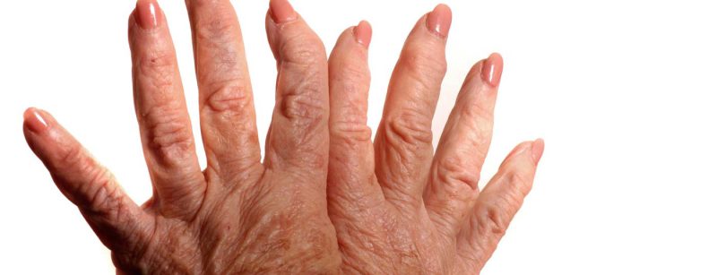 rheuma-arthritis_hand